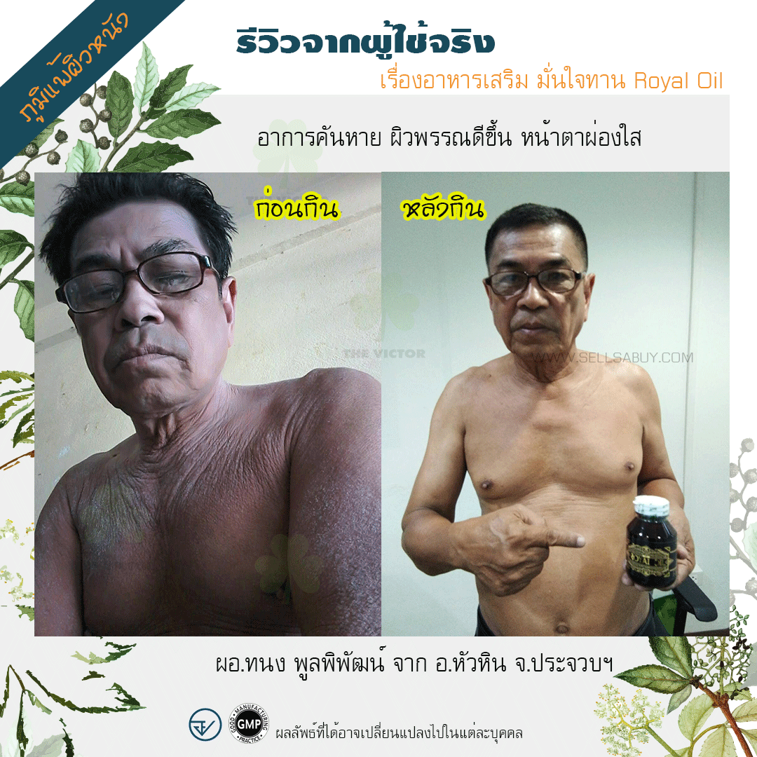 ภูมิแพ้ผิวหนัง-รักษา