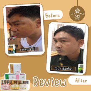 ครีม m9 ลดสิว ฝ้า ผู้ชาย